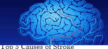 Top 5 causes of Stroke